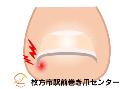 巻き爪矯正の図解